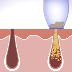 Mediashop.tv Körperpflege & Hygiene-Derma Suction Vakuum-Hautreiniger