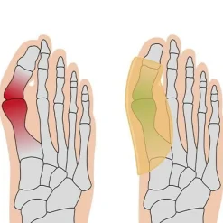 Sonstiges Gesundheit & Wohlbefinden|Massage & Wellness-Hallux Polster , 1 Paar