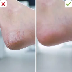 Mediashop.tv Nützliche Helfer Für Das Beste Alter|Körperpflege & Hygiene-PediVac elektrischer Hornhautentferner mit Saugfunktion 1+1 GRATIS