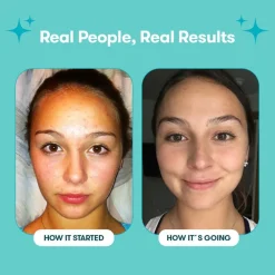 Proactiv Körperpflege & Hygiene|Kosmetik-Solution 30 Tage Routine 150 ml + 30 Zits Happen Patches